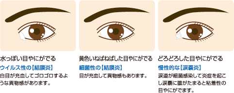 症状から探す 本田眼科 さいたま市大宮区 大宮駅1分 コンタクトレンズ処方 日曜日